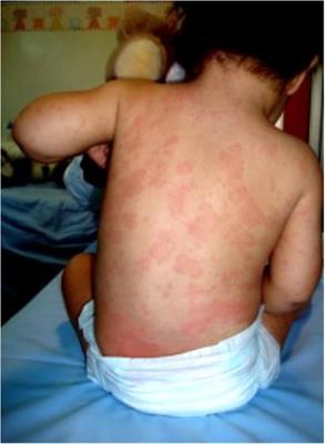 Case Report: Efficacy, safety, and favorable long-term outcome of early treatment with IL-1 inhibitors in a patient with chronic infantile neurological cutaneous articular (CINCA) syndrome caused by NLRP3 mosaicism